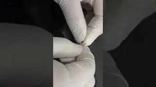 Fibrin Thread Visualization in capillary tube method for clotting time.