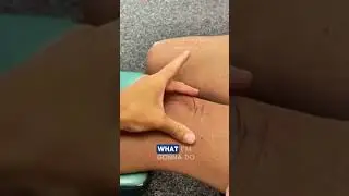 Cupping After TKR to Reduce Skin Adhesions