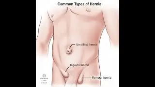 Human Anatomy & Physiology; Diseases of the Intestines; Hernias:- 153. #intestine #hernia #anatomy