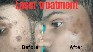Laser treatment of scar | Scar revision surgery in Ranchi | Best scar treatment in Ranchi #scar 