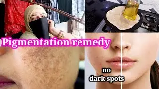 Pigmentation remedy | no dark spots | BinteSaeed Kitchen and life