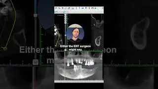 Sinus Lift Pathology #dentalimplants #implantdentist #sinuslift #pathology