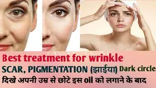 Bio oil review। best skin oil। best skin oil for acne scar।wrinkle pigmentation। Dark circle