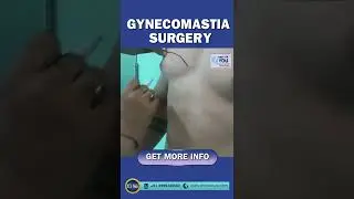 Preoperative Marking in Gynecomastia Surgery, Male Breast Reduction Surgery in Delhi, Dr. PK Talwar