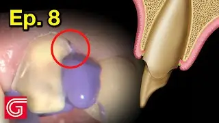 HOW TO Take an Ideal Impression for ANTERIOR Tooth: Ep 8