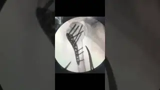 Proximal humerus / shoulder fracture Fixation #medicaleducation #hospital