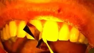 Repair of Chipped Tooth