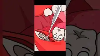 Impacted Wisdom Tooth Surgery Animation 💉🦷 #satisfying