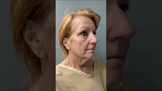 65 is the New 45! Full Facial Rejuvenation On 65 Year Old 🤯