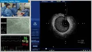 Reattempt CTO PCI of LCx Using Anterograde Approach