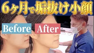 【頬&顎下 脂肪吸引】写真を撮られるのが嫌だったクラシック歌手が、写真写りに自信が持てる小顔になりました！