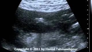 Duodenal Ulcer