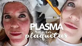 ME INYECTAN PLASMA RICO EN PLAQUETAS / MARTA IBRAHIM