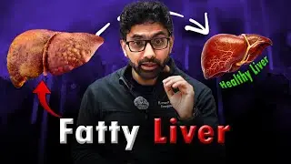 Fatty Liver: Silent Killer & Natural Detox Tips