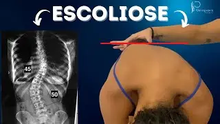 ESCOLIOSE COM QUIROPRAXIA