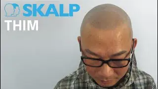 Best Hair Loss Solution for Bald Men? Thim Shares His Real SMP Results | Skalp&reg;