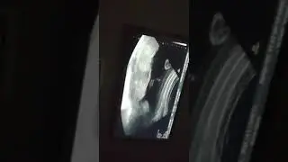 Hunter Keith Chatman ultrasound