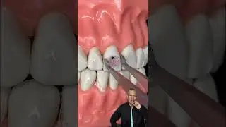 🔥Instalaci&oacute;n de Brackets Est&eacute;ticos de ORTODONCIA🔥