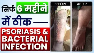 How she cured 6- year psoriasis & infection naturally | real recovery story with Bharat Homeopathy