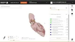 New FEops HEARTguide Release, TAVI Anatomical Analysis