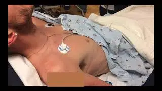 Kussmaul Breathing in Diabetic Ketoacidosis (DKA)