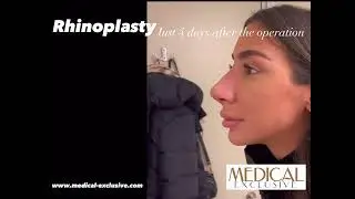 Almost 4 days after post-op after Rhinoplasty by Medical Exclusive