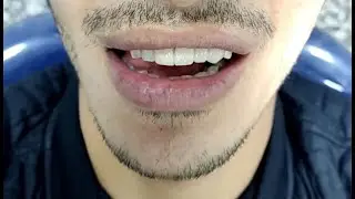 Metal Framework of PFM Dental Bridge, metal checks pfm