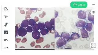 Myeloblast vs Lymphoblast (Learn the difference b/w them)