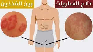 علاج الفطريات بين الفخذين