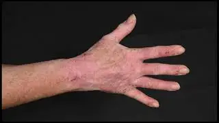 JID May 2024 Cover: Spotlight on Atopic Dermatitis