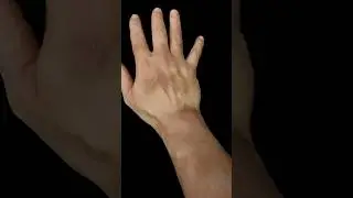 Post Assault Bruising