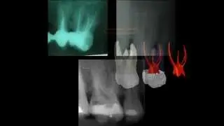 Primer molar superior
