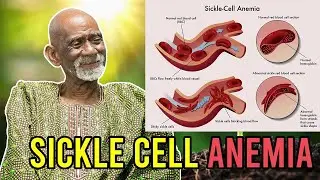 Natural Remedy For Sickle Cell Anemia By Dr Sebi