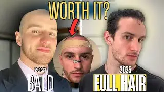 Are Hair Transplants Worth it? Hair Loss Protocols & BIG SECRET