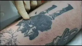 RevLite SI Laser Tattoo Removal, 