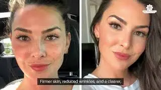 Morpheus8 Results in Dallas, TX | Skin Rejuvenation & Maintenance Tips