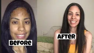 Is witch hazel good for your skin?! I tried witch hazel and this happened.