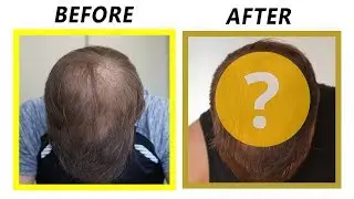 5 months after my 3 PRP Sessions!
