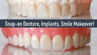 Snap on Denture, Implant Dentures, Smile Makeover!