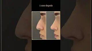 Rinoplastia Preservadora: T&eacute;cnica Espetacular para Resultados Naturais