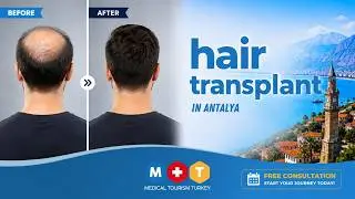 Hair Transplant & Luxury Medical Tourism in Antalya | Medical Tourism Turkey Experience