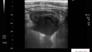 Apendicitis con plastron