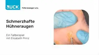 Effektive Behandlung von schmerzhaften H&uuml;hneraugen bei empfindlicher Haut
