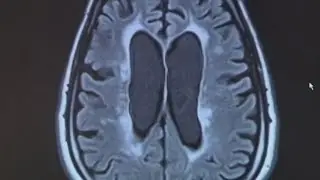 Shingles vaccine may slow, prevent dementia progression, study finds