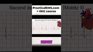 Heart Block Explained: Understanding Intermittent AV Node Issues