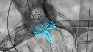 Aortic Heart Valve Implantation (Advanced Device) - Medical & Scientific Video Production