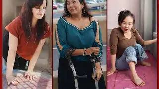 ✅📣 SEVERE POLIO IN LEGS AND FEET🚨