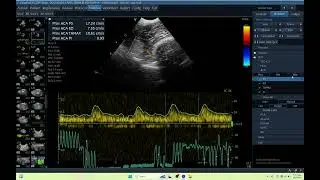 IQ 435 TCD BRAIN ULTRASOUND ECHO PAC ANALYSIS