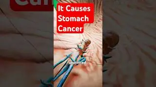 Stomach Cancer 🦠  H Pylori Explained