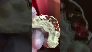 6pc 10k Gold Perm Cut Top Grillz by Seattle Gold Grills is a Best Seller!